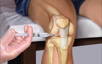 Intra-articular injection for arthrosis of the joint