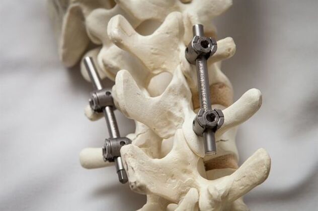 Fixation of osteochondrosis of the cervical spine