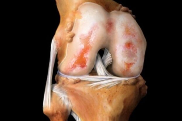 Cartilage damage during knee arthrosis