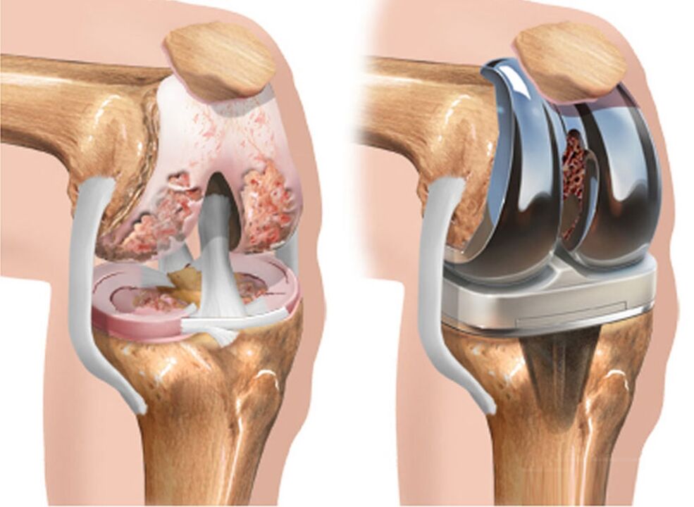 For osteoarthritis of the knee joint before and after arthrosis