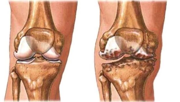 Healthy arthrosis of the knee and knee