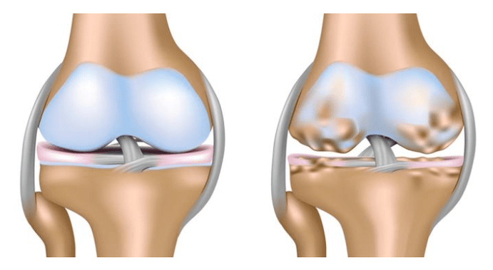 Healthy cartilage and damage to the knee joint with arthrosis