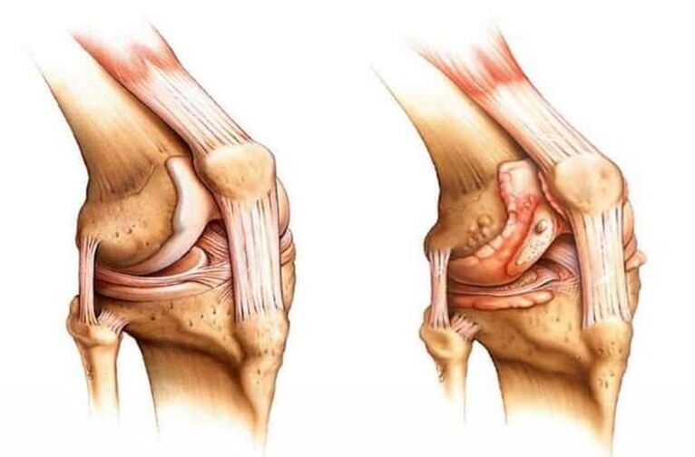Healthy knee and arthrosis of the knee joint