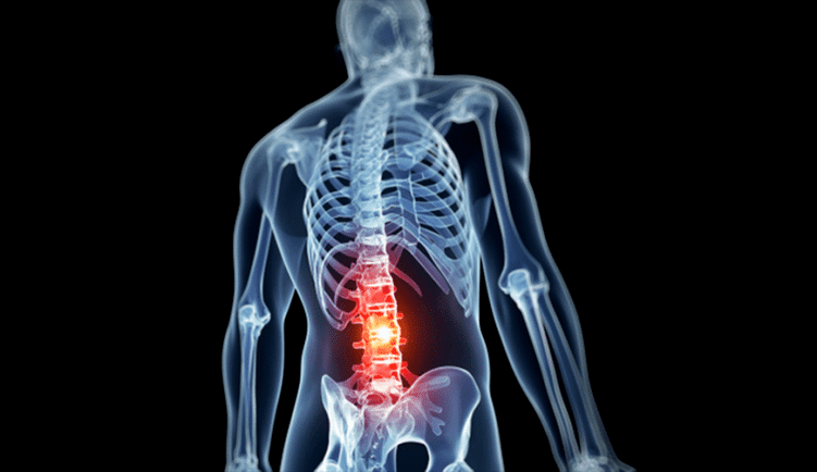 Damage to the lumbar spine during osteochondrosis