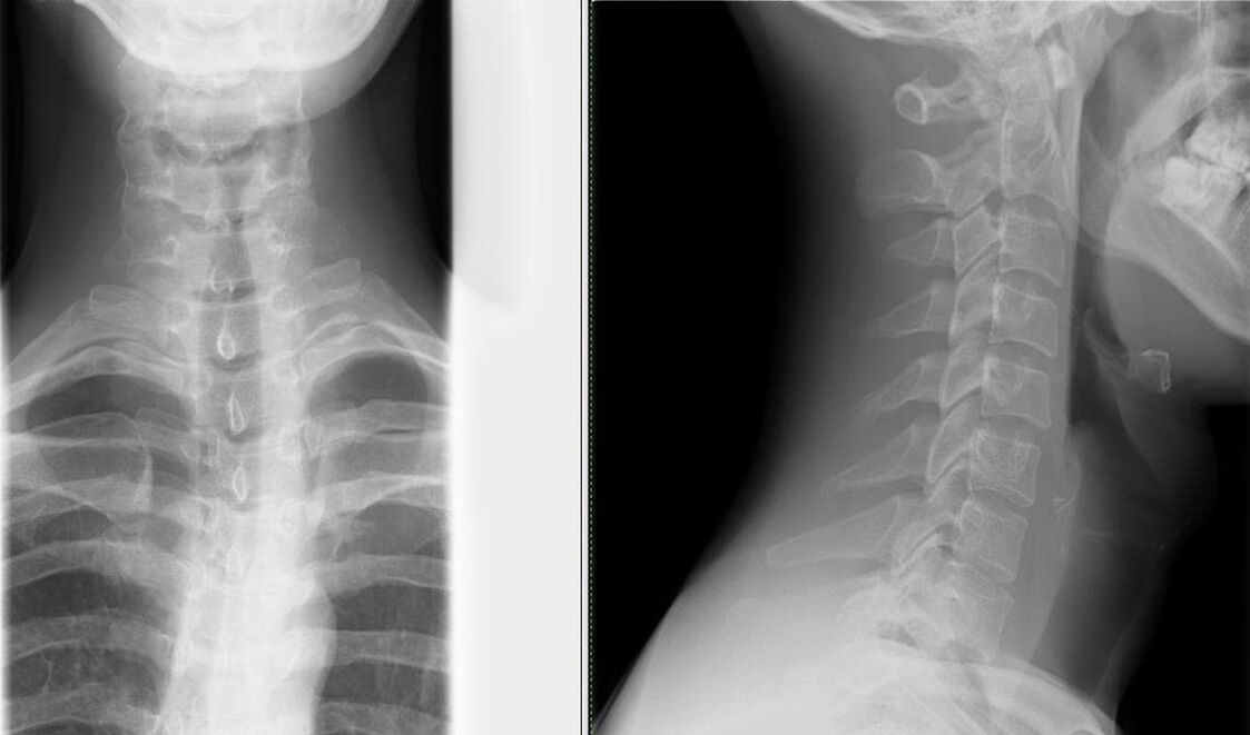 X-ray of the spine is a simple and effective method of diagnosing osteochondrosis