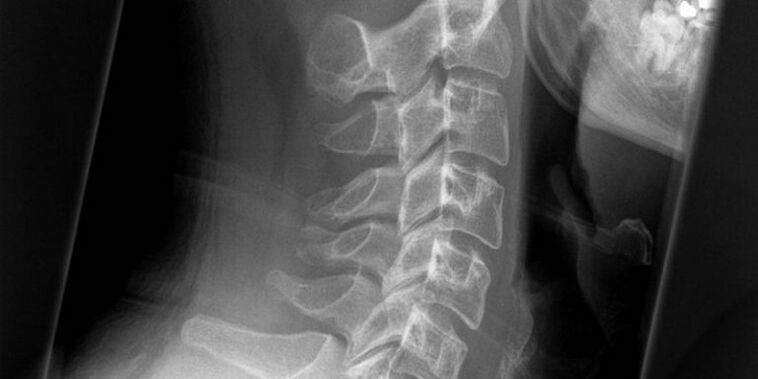 A picture of a cervical region