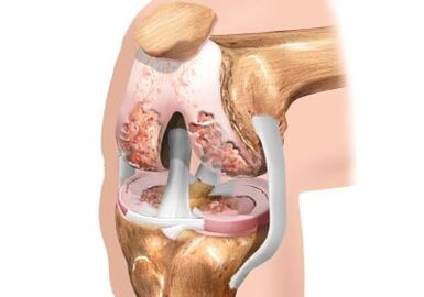 Injury to the knee joint arthrosis