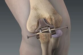Knee replacement in arthrosis
