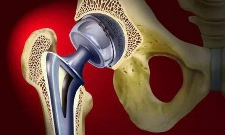 Endoprosthesis