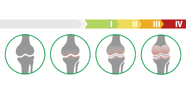 Stages of atrophy